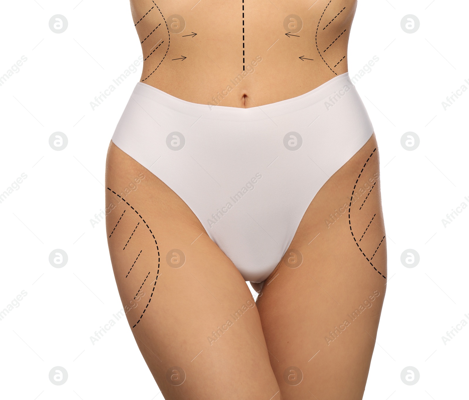 Image of Woman with markings for cosmetic surgery on her abdomen against white background, closeup