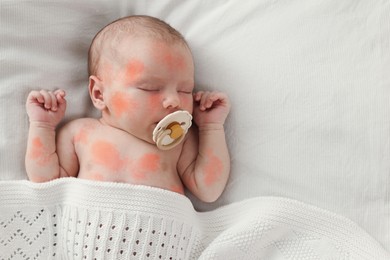 Image of Cute little baby with allergic redness sleeping in bed, top view. Space for text