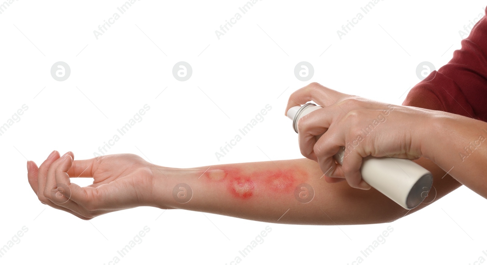 Photo of Woman applying panthenol onto burned hand on white background, closeup