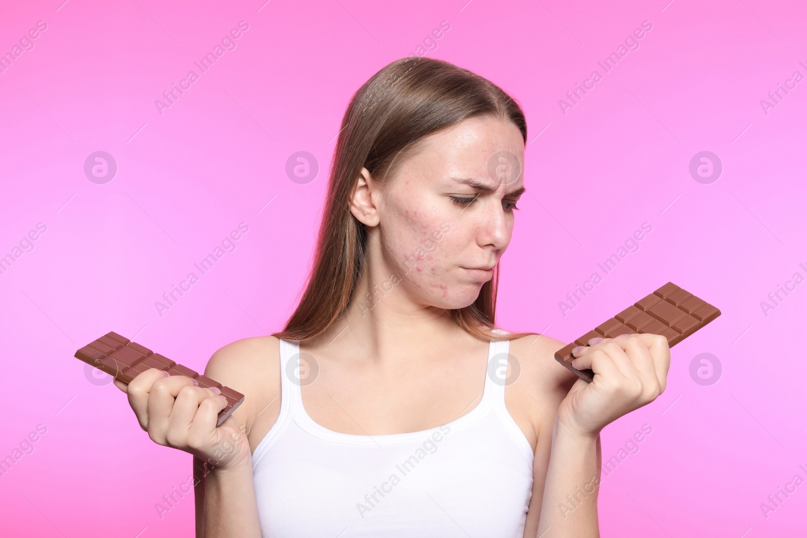 Photo of Young woman with acne problem holding chocolate bars on color background. Skin allergy