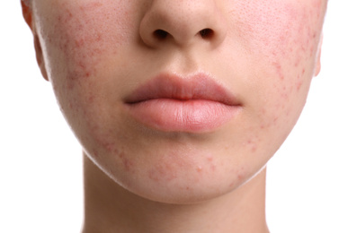 Teenage girl with acne problem on white background, closeup