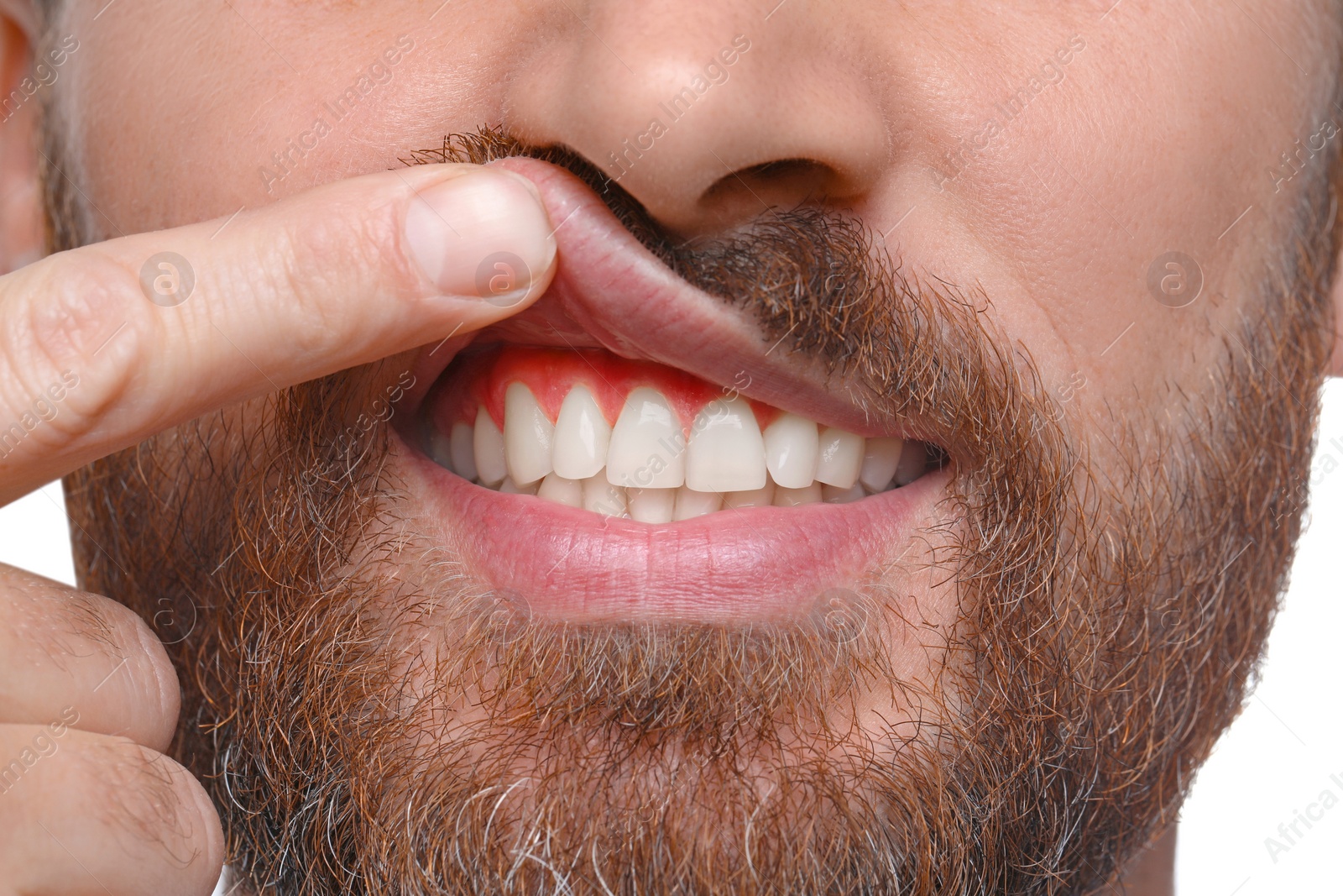 Image of Man showing inflamed gum, closeup. Oral cavity health