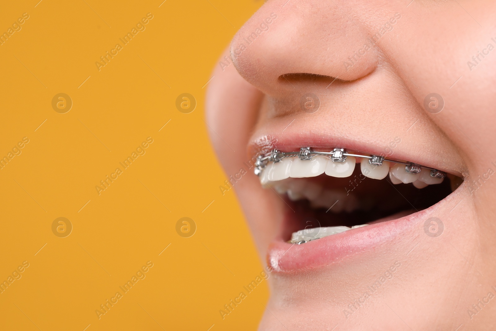 Photo of Smiling woman with dental braces on orange background, closeup. Space for text