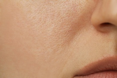 Macro view of woman with dry skin