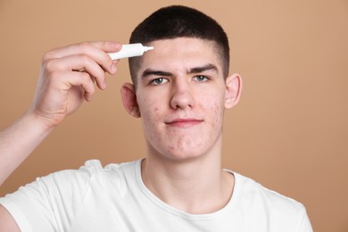 Young man with acne problem applying cosmetic product onto his skin on beige background