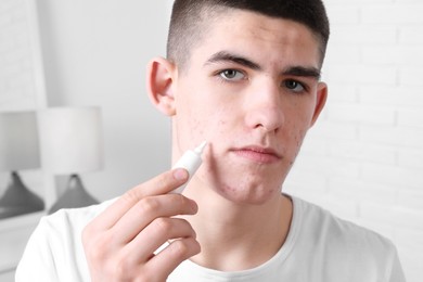 Young man with acne problem applying cosmetic product onto his skin indoors