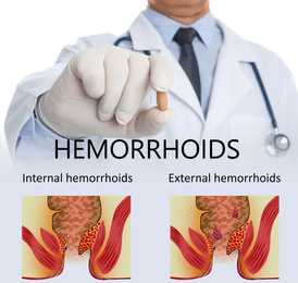 Image of Doctor holding suppository for hemorrhoid treatment over illustrations of unhealthy lower rectum 