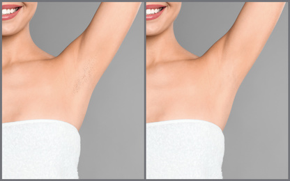 Image of Collage of woman showing armpit before and after epilation on light grey background, closeup 