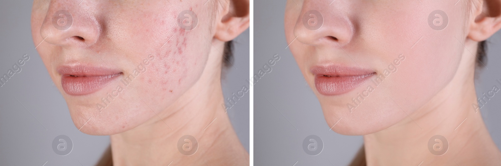Image of Acne problem. Young woman before and after treatment on grey background, closeup. Collage of photos