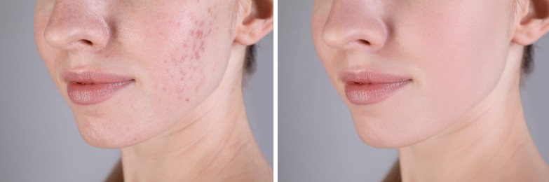 Image of Acne problem. Young woman before and after treatment on grey background, closeup. Collage of photos