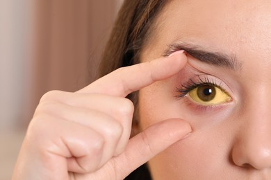 Photo of Woman with yellow eyes on blurred background, closeup. Symptom of hepatitis