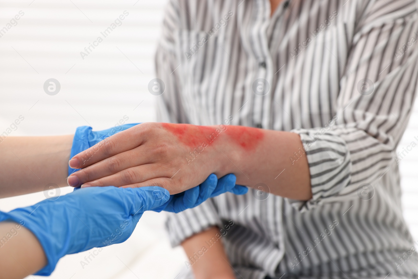 Photo of Doctor examining patient's burned hand indoors, closeup