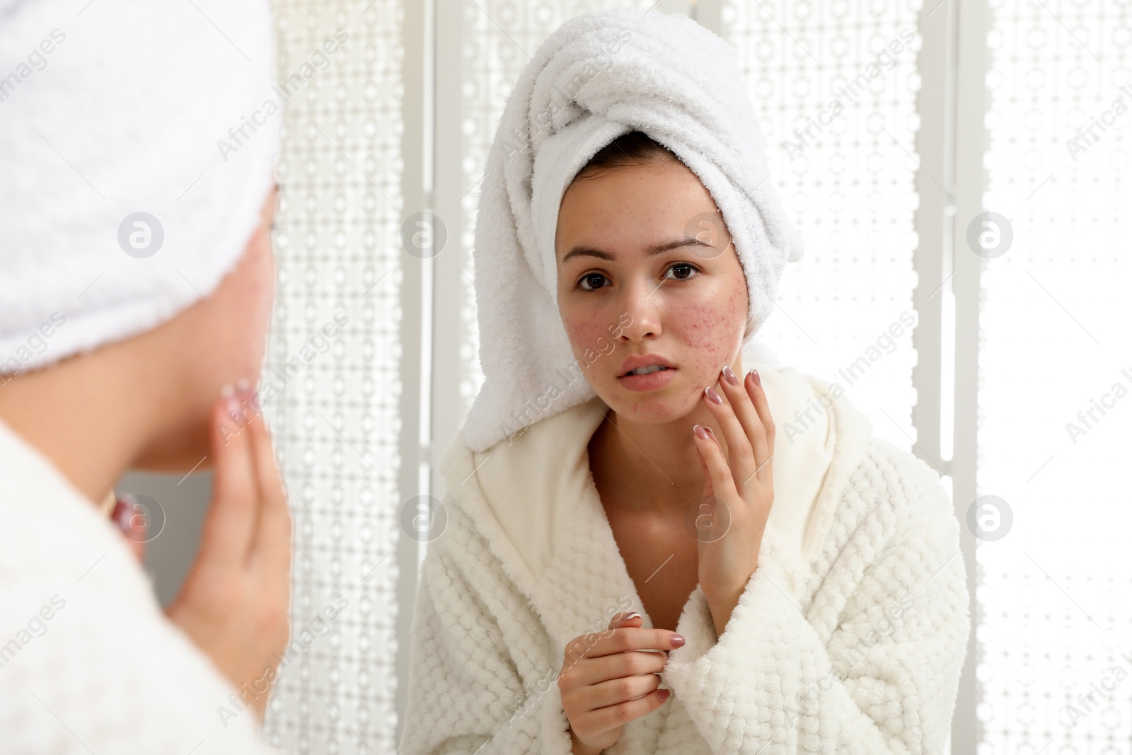 Photo of Teen girl with acne problem near mirror in bathroom