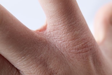 Woman with dry skin on hand against light background, closeup