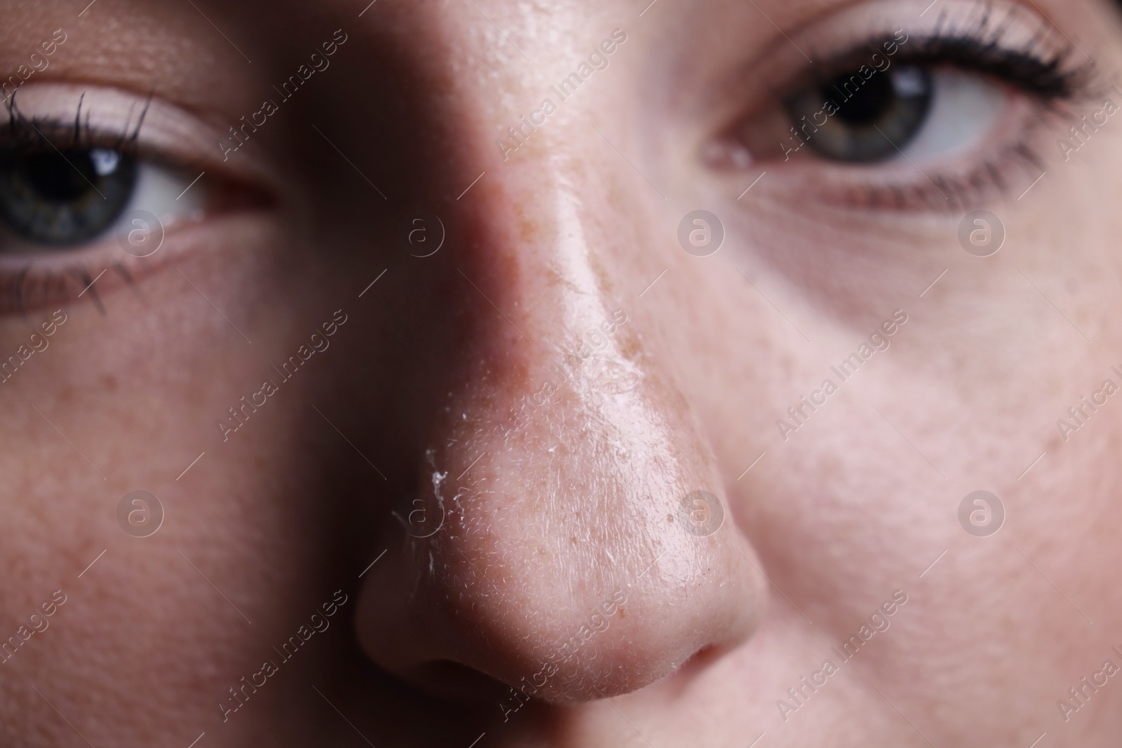 Photo of Woman with dry skin on nose, macro view