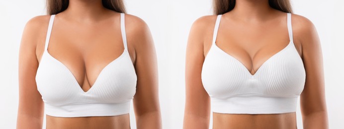 Image of Collage with photos of woman before and after breast-lift surgery on white background, closeup
