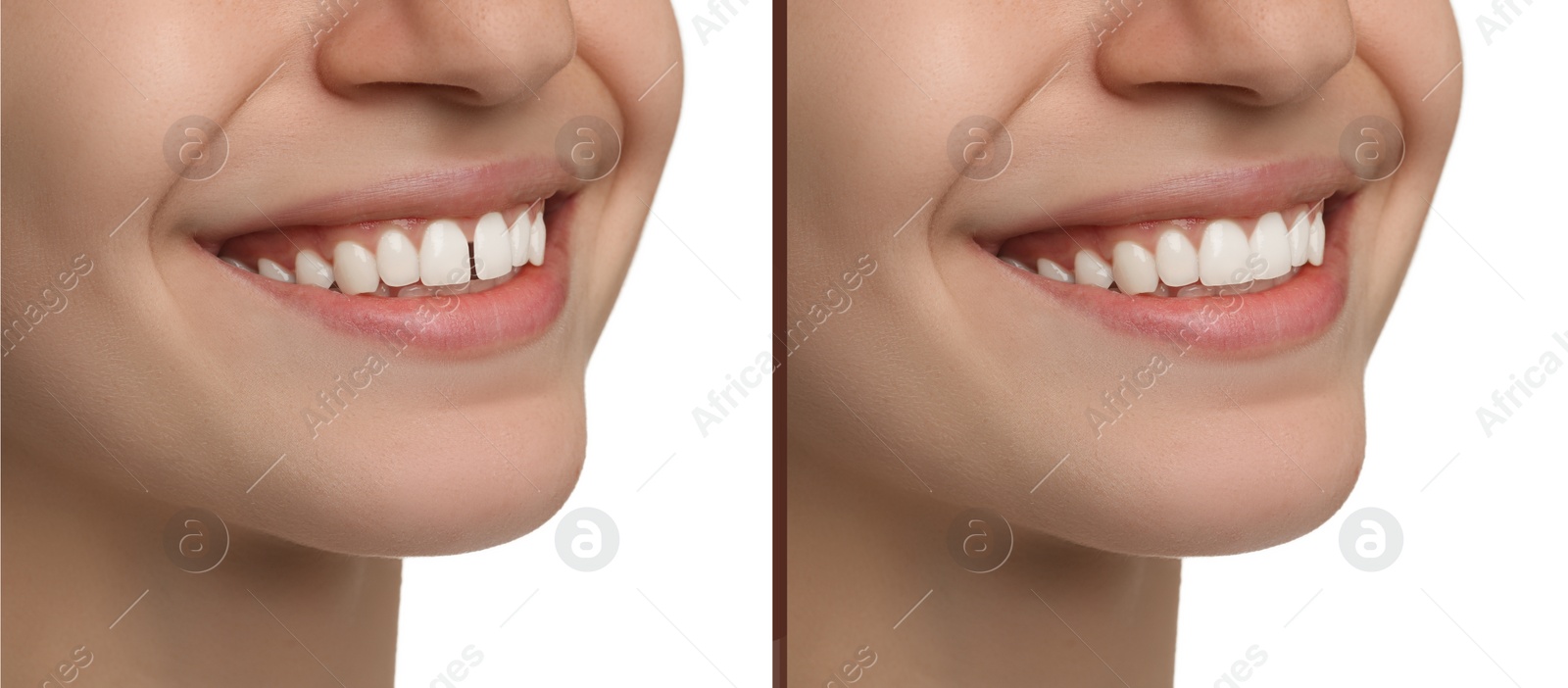 Image of Collage with photos of woman with diastema between upper front teeth before and after treatment on white background, closeup. Banner design