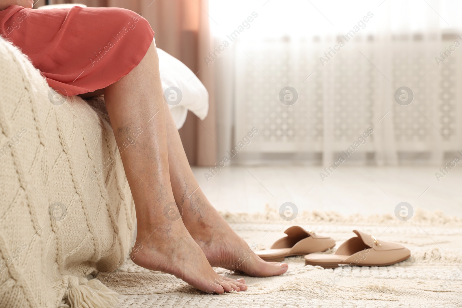 Photo of Woman suffering from varicose veins at home, closeup. Space for text