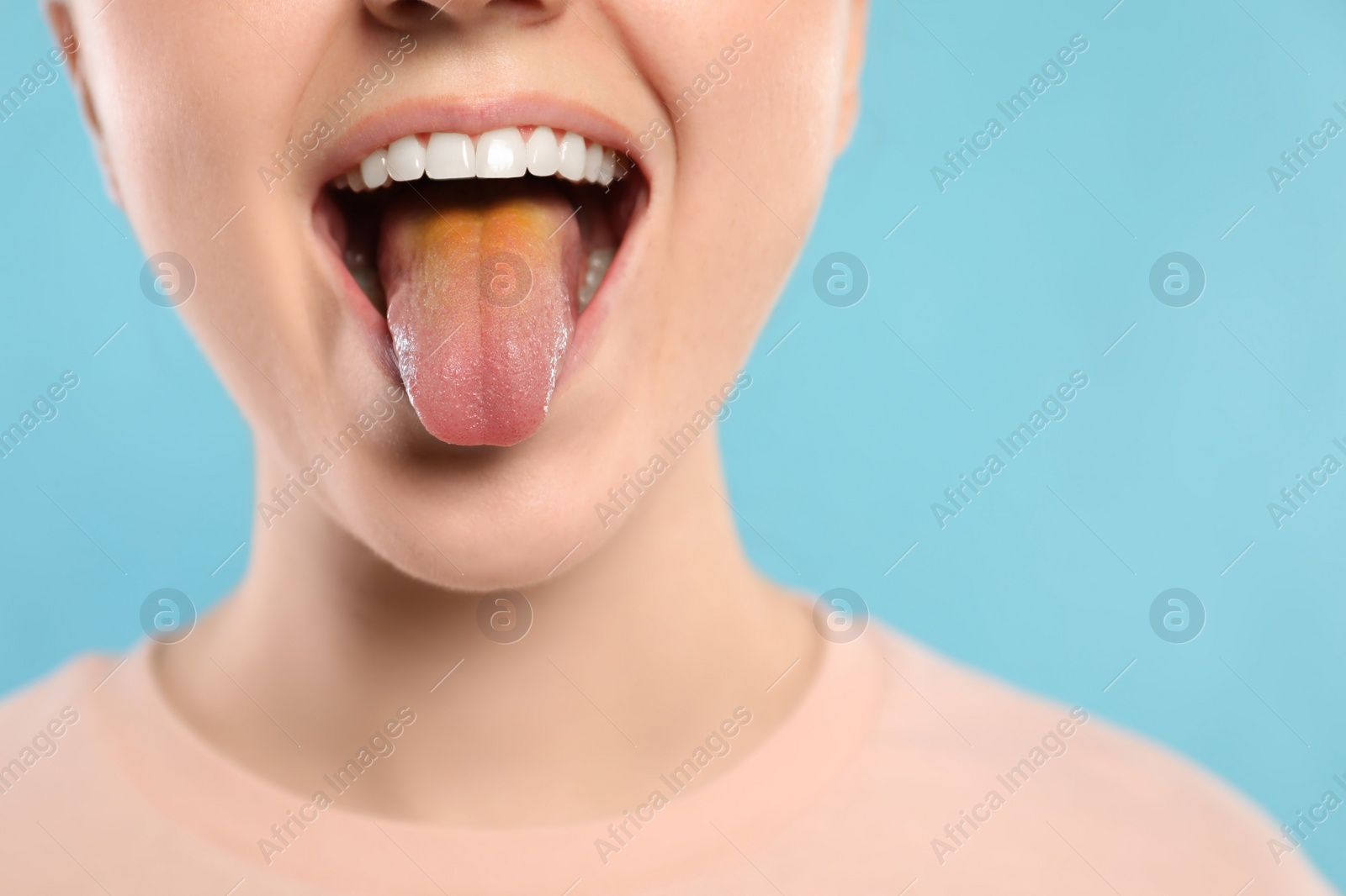 Photo of Gastrointestinal diseases. Woman showing her yellow tongue on light blue background, closeup. Space for text