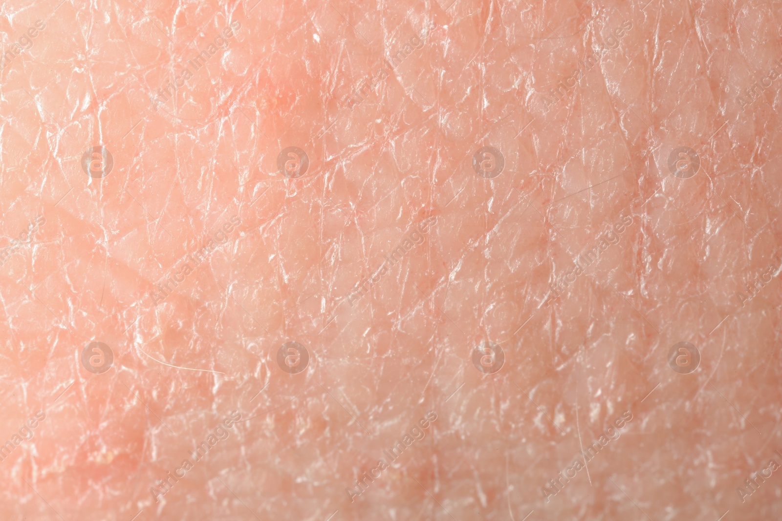 Photo of Texture of dry skin as background, macro view