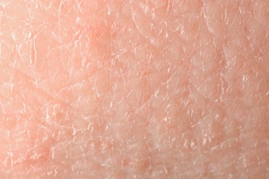 Photo of Texture of dry skin as background, macro view