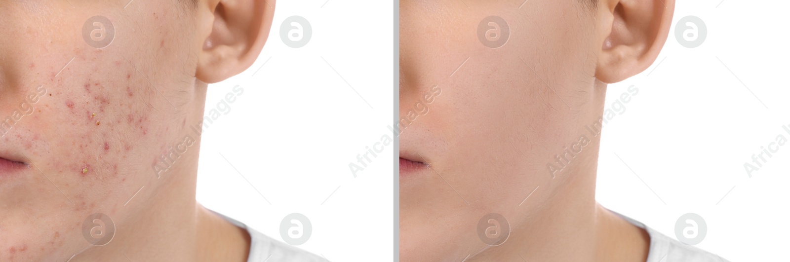 Image of Acne problem. Young man before and after treatment on white background, closeup. Collage of photos
