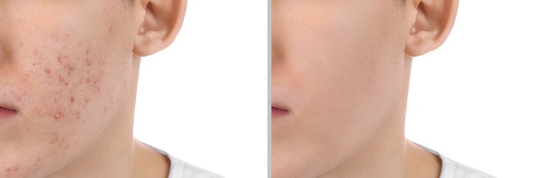Acne problem. Young man before and after treatment on white background, closeup. Collage of photos