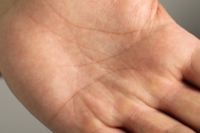 Closeup view of human palm with dry skin