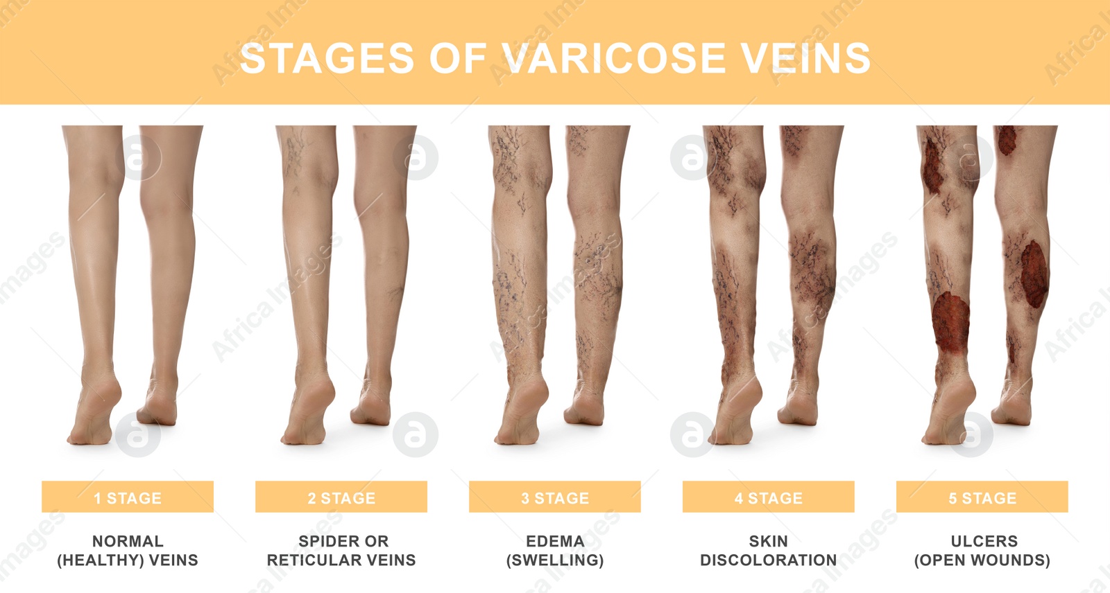 Image of Stages of varicose veins. Collage with photos of woman showing changes during different phases, closeup of legs