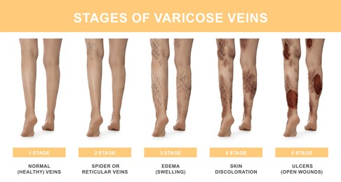 Stages of varicose veins. Collage with photos of woman showing changes during different phases, closeup of legs