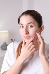 Photo of Young woman with acne problem at home