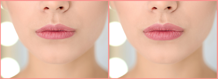 Image of Woman before and after lip correction procedure, closeup. Banner design 