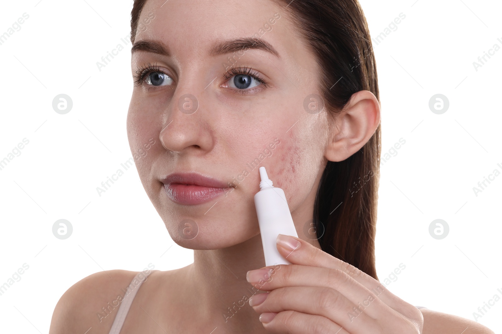 Photo of Young woman with acne problem applying cosmetic product onto her skin on white background