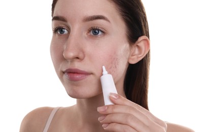 Young woman with acne problem applying cosmetic product onto her skin on white background