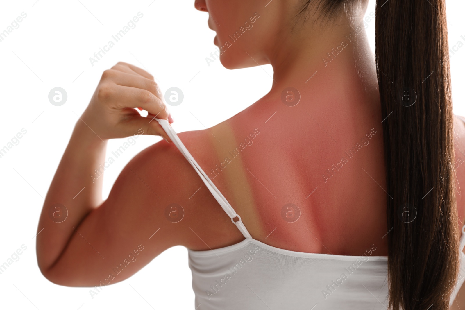 Photo of Woman with sunburned skin at home, closeup