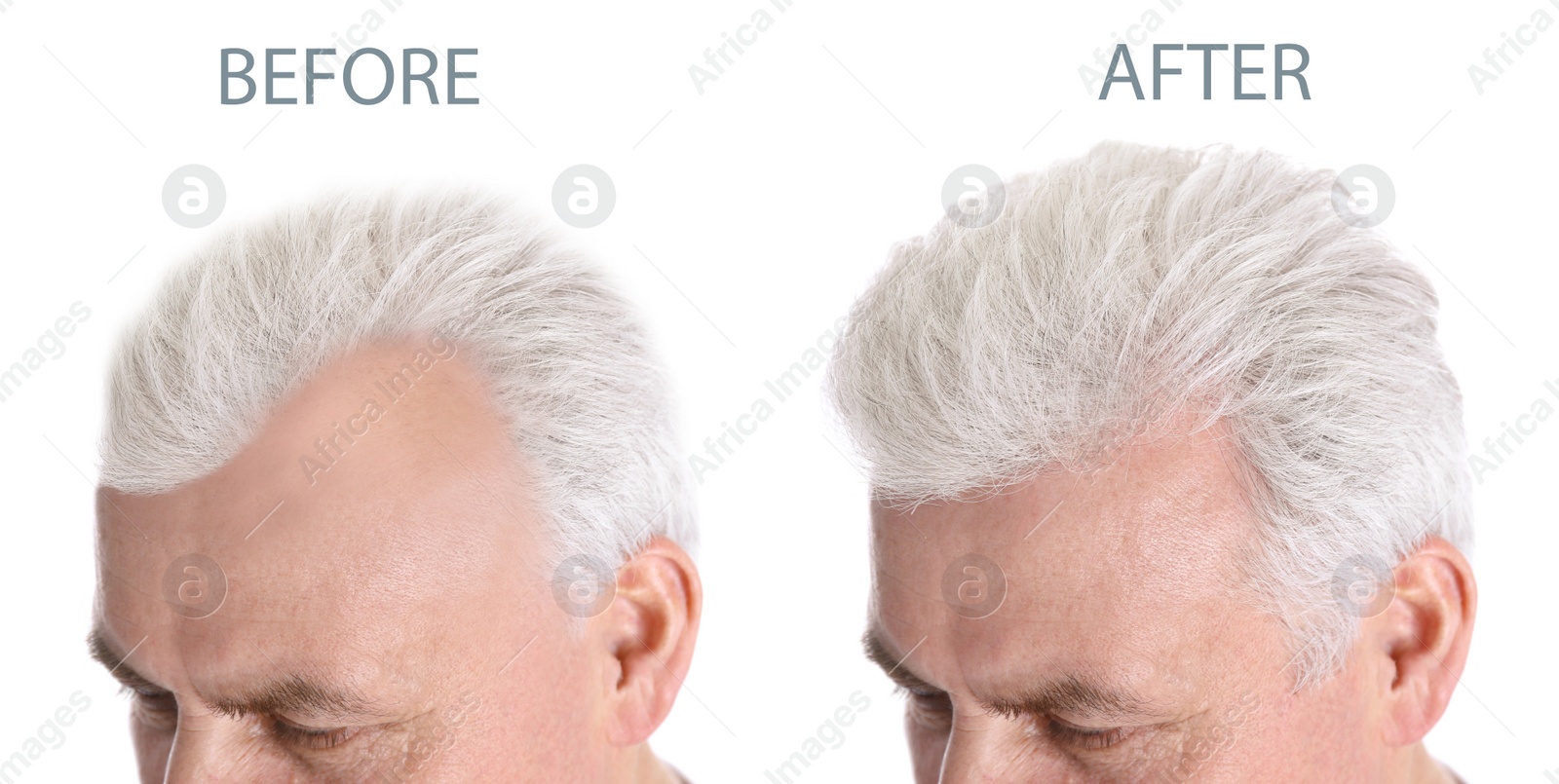 Image of Closeup view of senior man before and after hair loss treatment on white background, collage. Banner design