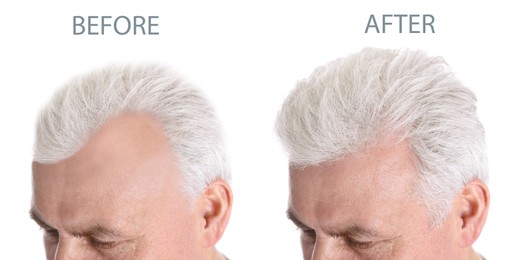 Image of Closeup view of senior man before and after hair loss treatment on white background, collage. Banner design