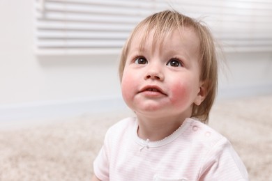 Photo of Portrait of little girl with diathesis symptom on cheeks indoors, closeup. Space for text