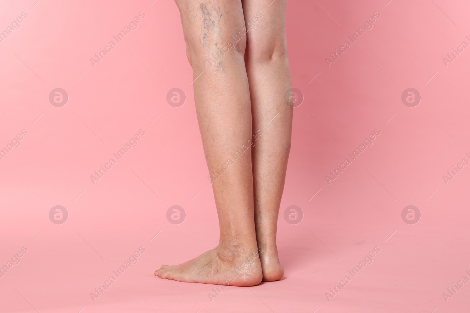 Photo of Closeup view of woman with varicose veins on pink background