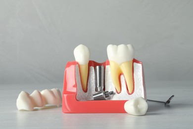 Photo of Educational model of gum with post for dental implant between teeth and crowns on white wooden table