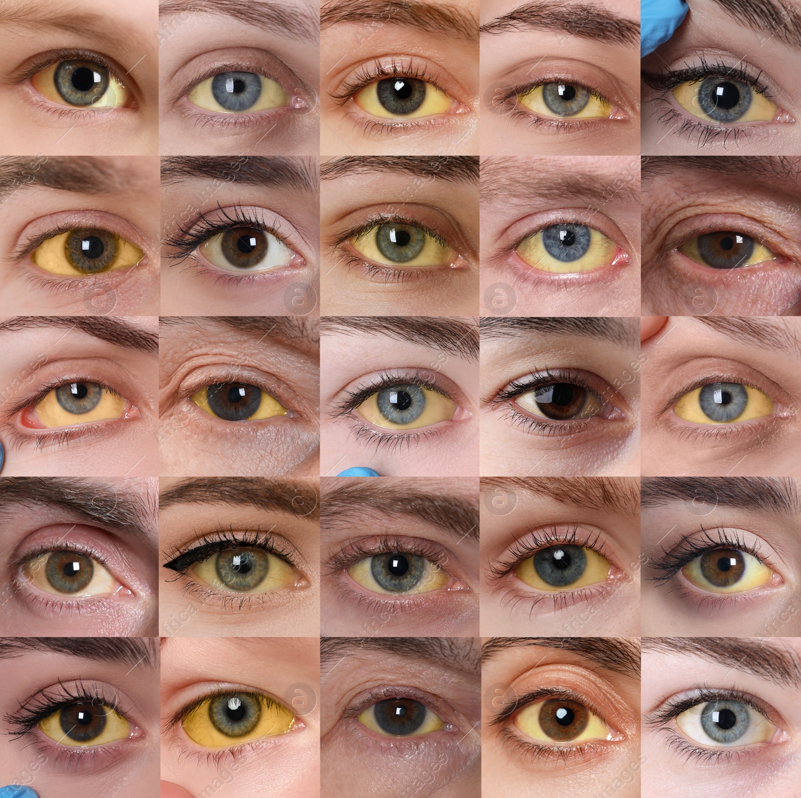 Image of Yellowing of eyes as symptom of hepatitis. Collage with photos of people