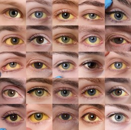Image of Yellowingeyes as symptom of hepatitis. Collage with photos of people