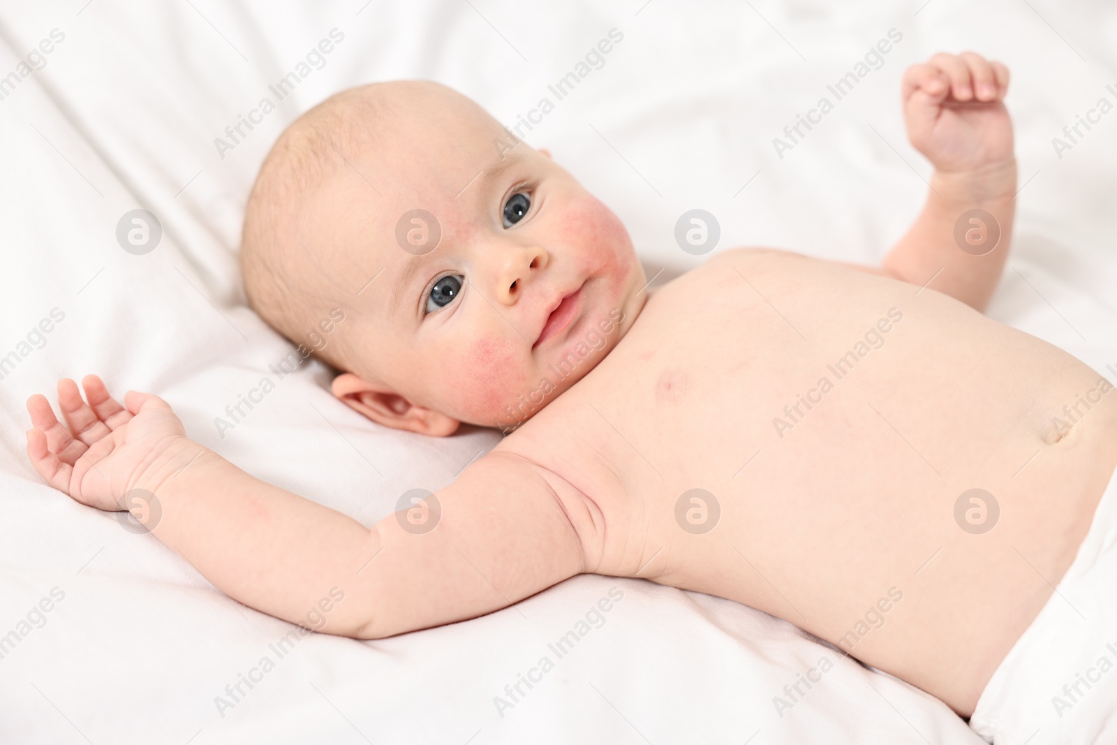 Photo of Cute little baby with allergic redness on cheeks lying on white blanket