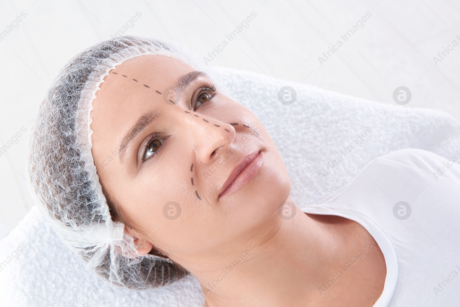 Photo of Mature woman with marks on face before cosmetic surgery in clinic