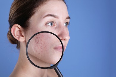 Young woman with acne problem holding magnifying glass near her skin on blue background, closeup. Space for text