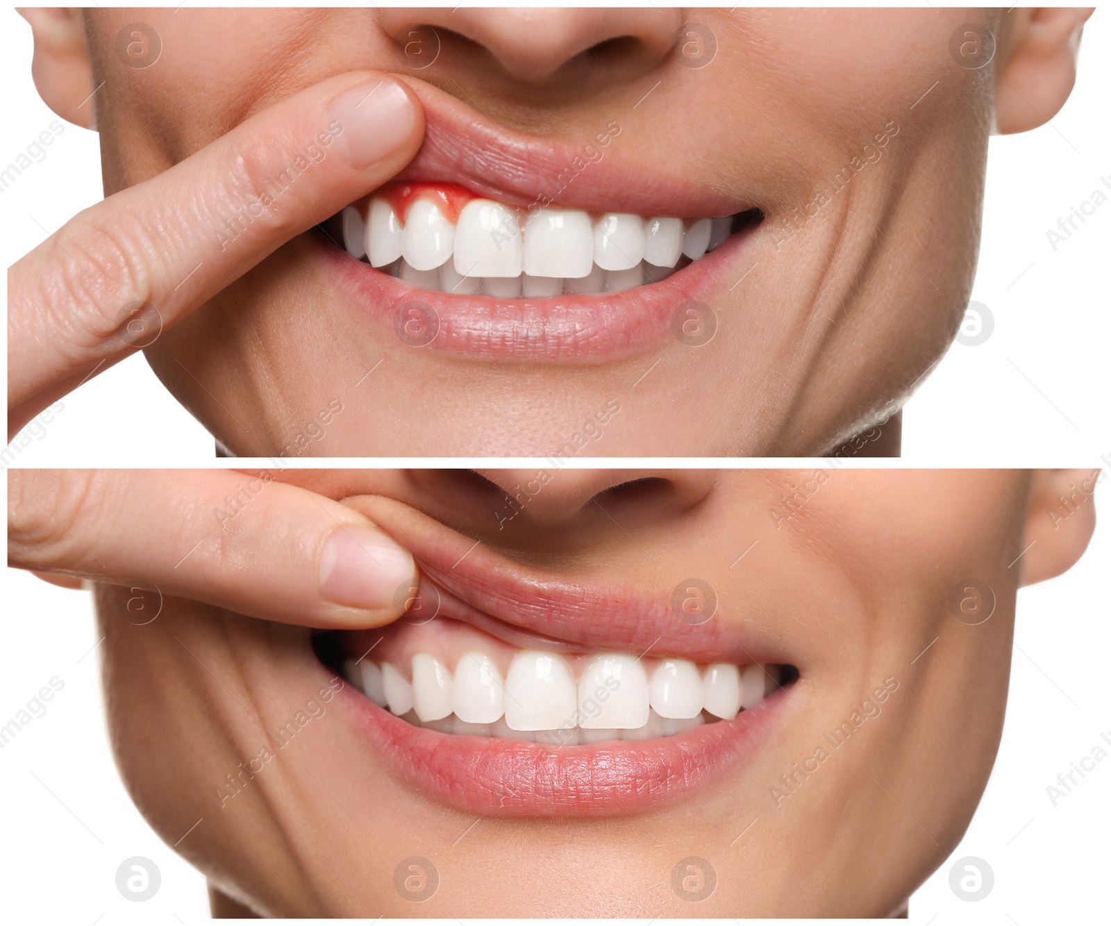 Image of Woman showing gum before and after treatment on white background, collage of photos