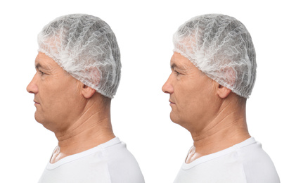 Image of Mature man before and after plastic surgery operation on white background. Double chin problem