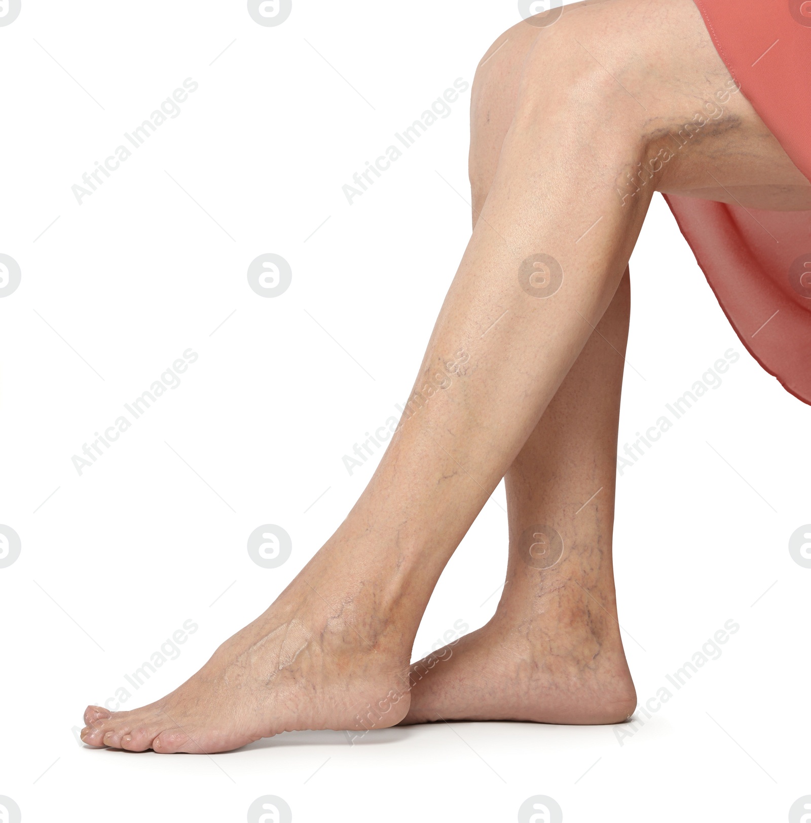 Photo of Closeup view of woman with varicose veins on light background. Space for text