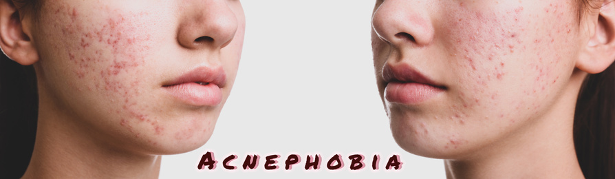 Acnephobia concept. Girl with problem skin, right and left cheeks