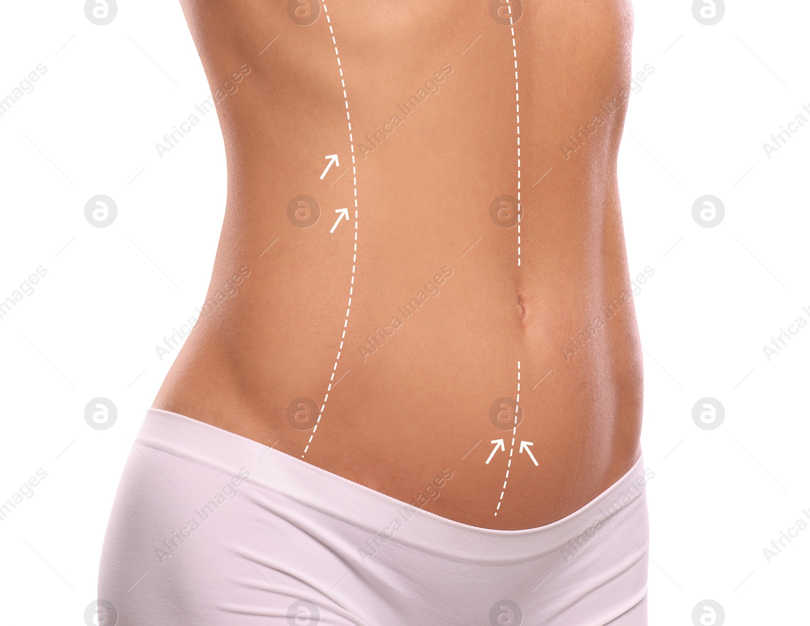 Image of Woman with markings for cosmetic surgery on her abdomen against white background, closeup
